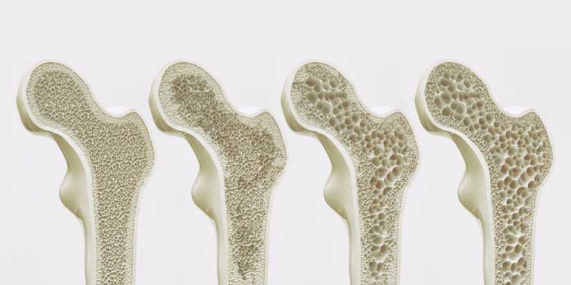 Диагностика остеопороза - расширенный скрининг