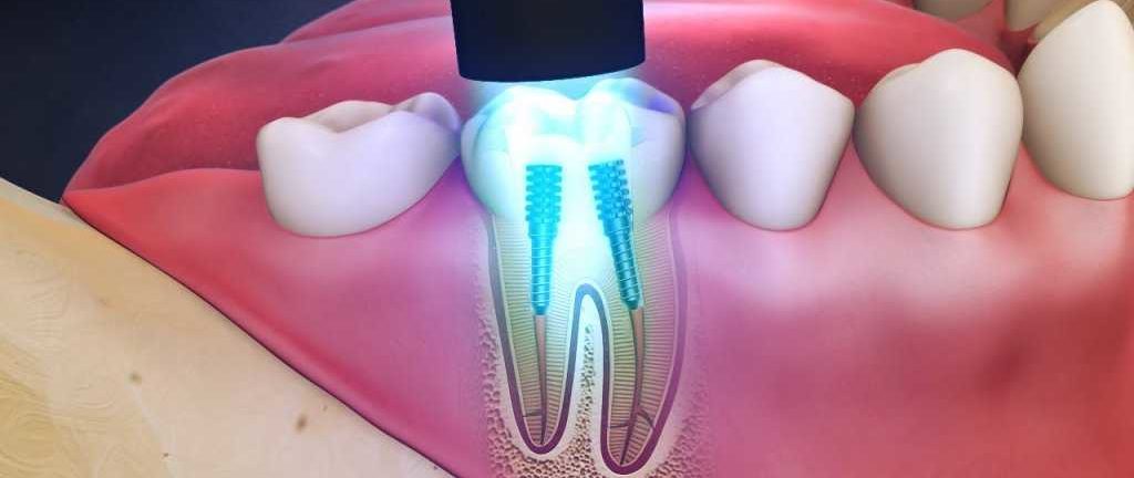 Эстетическое восстановление зубов при помощи внутриканальных штифтов