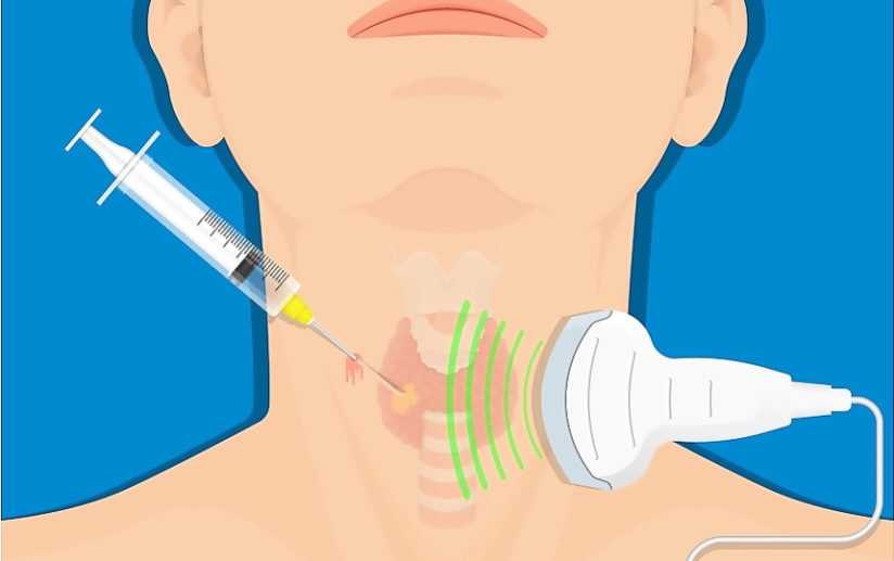 Биопсия щитовидной или паращитовидной железы под контролем УЗИ