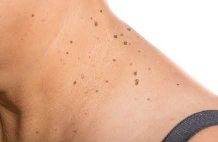 Лечение и удаление новообразований кожи