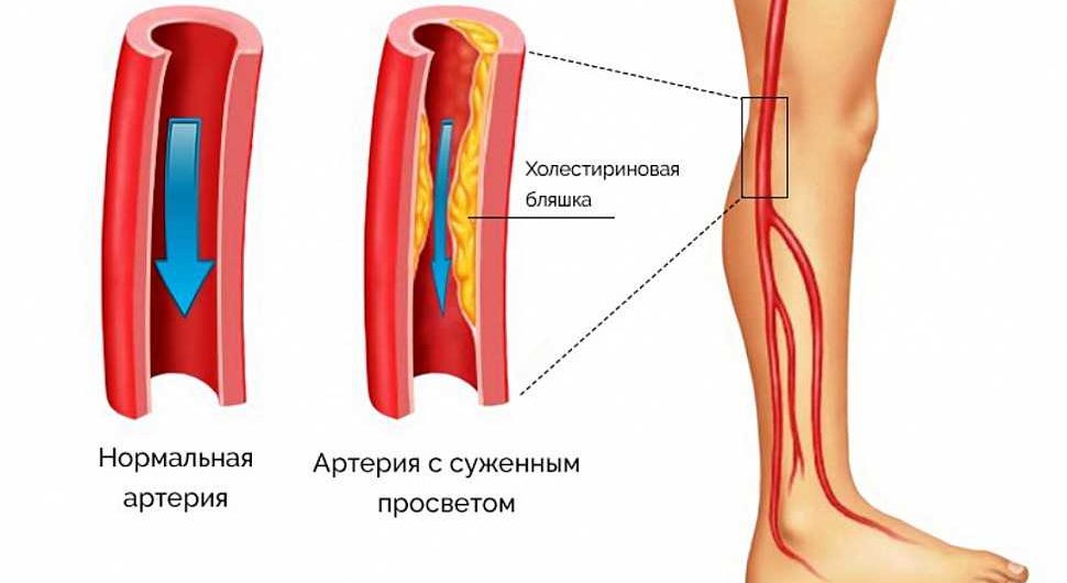 Атеросклероз артерий нижних конечностей
