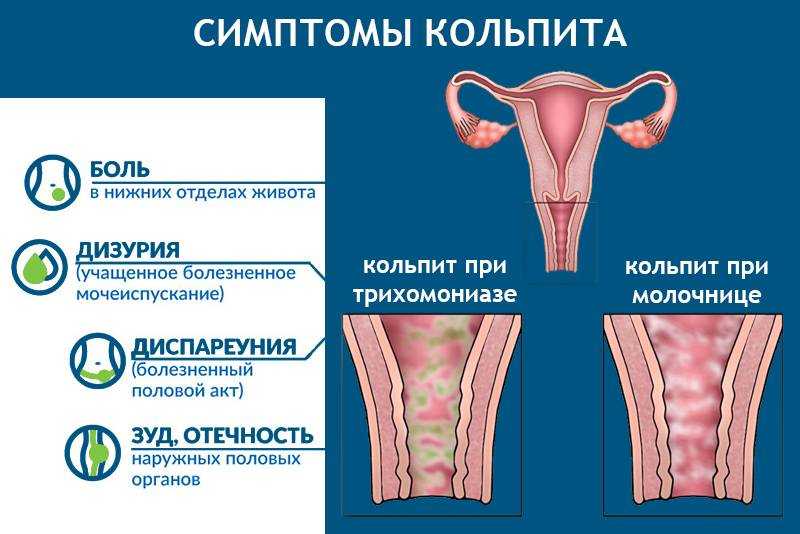 Кольпит (вагинит) - диагностика и лечение