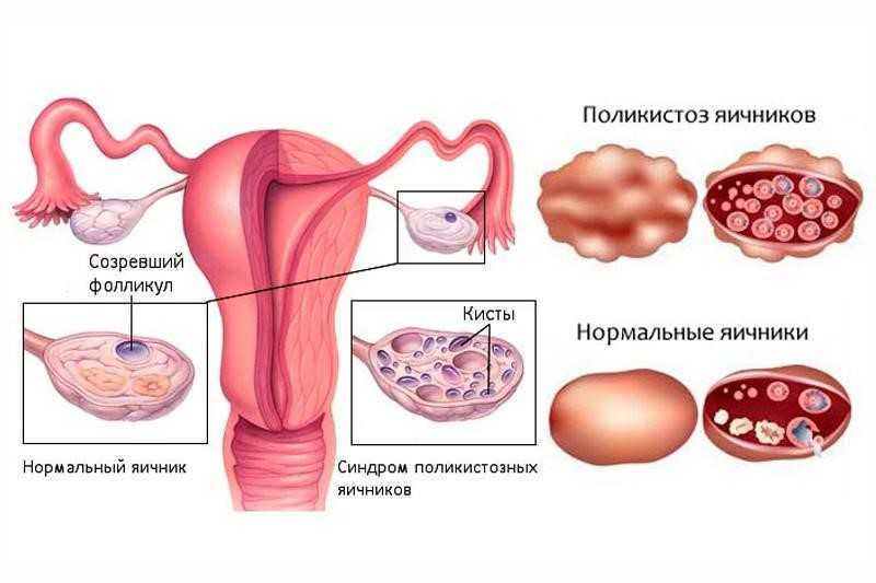 Синдром поликистозных яичников (мультифолликулярные яичники)