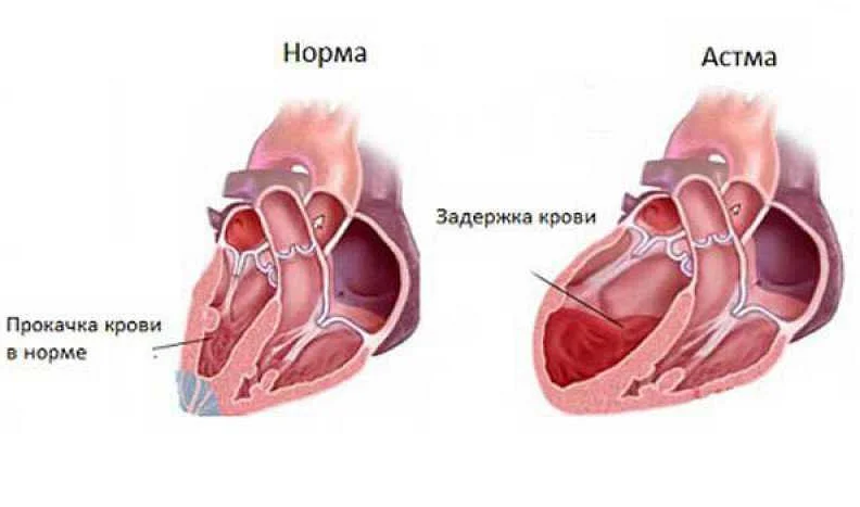 Сердечная астма - диагностика
