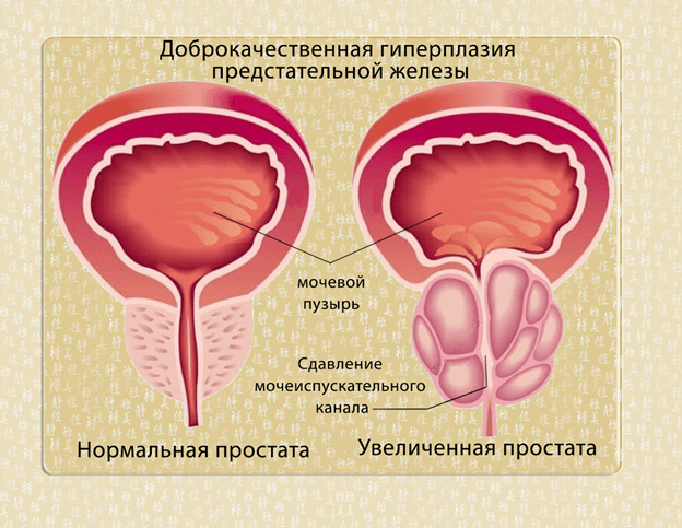 Доброкачественная гиперплазия (аденома) предстательной железы