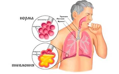 Пневмония - причины, лечение