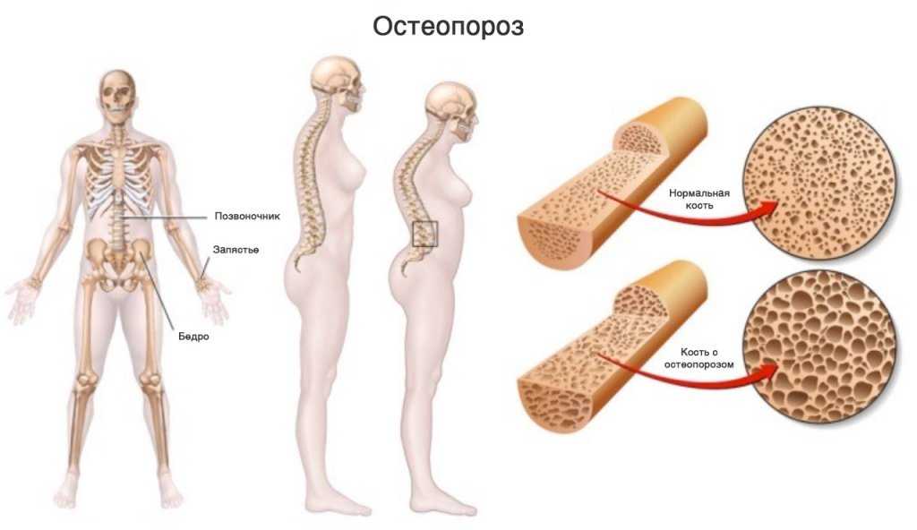 Остеопороз - причины, лечение