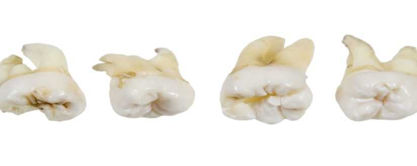Лечение 4-канальных зубов (зубов мудрости)