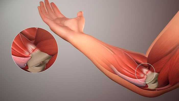 Ударно-волновая терапия при эпикондилите