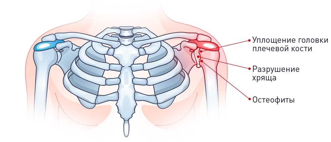 Артроз плечевого сустава