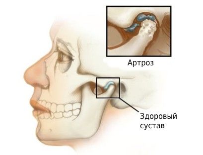 Артроз височно-нижнечелюстного сустава (ВНЧС)