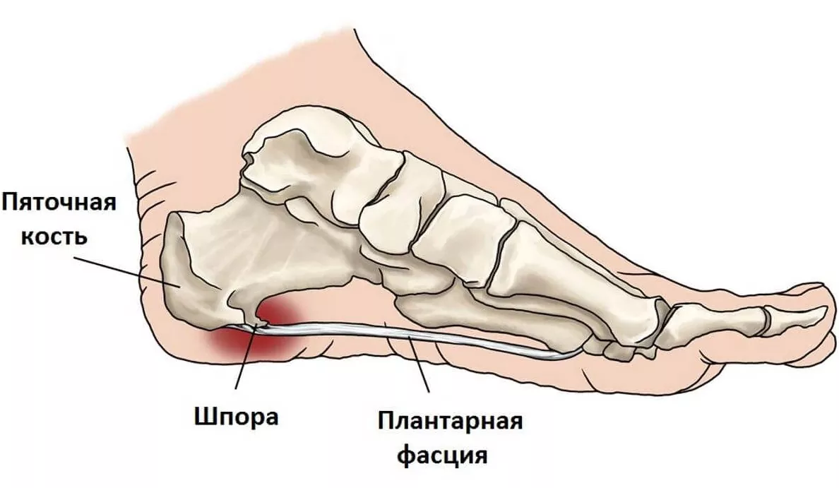 Пяточная шпора - причины и лечение