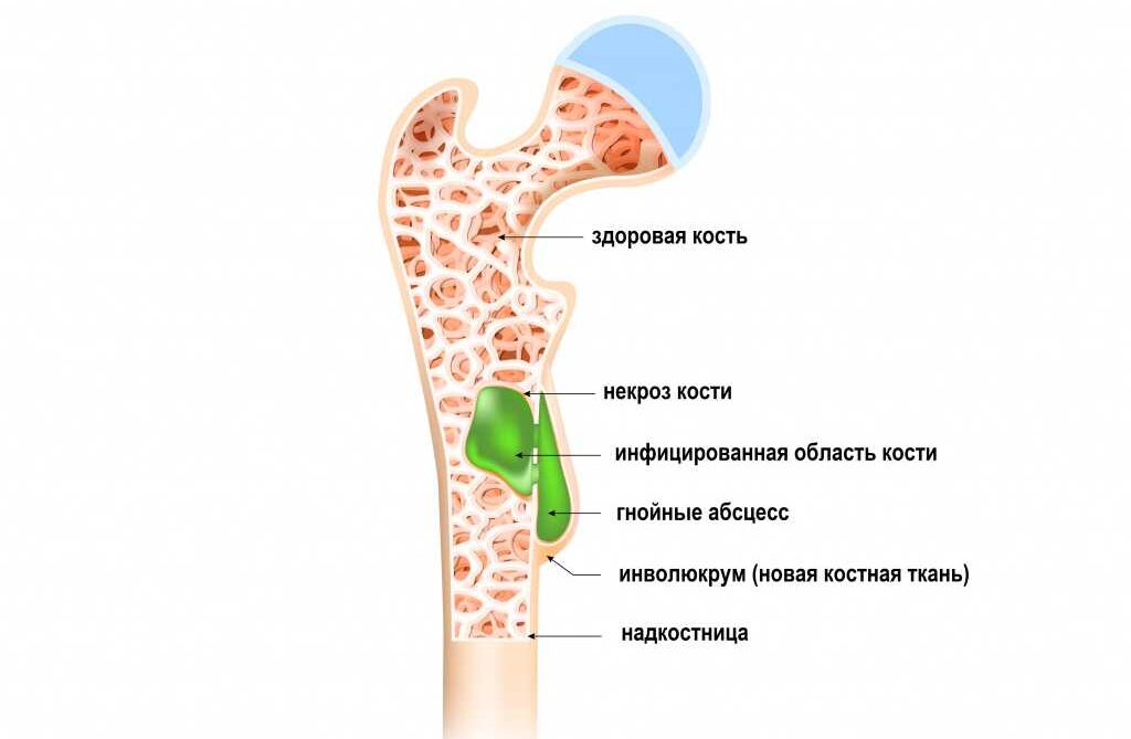 Остеомиелит - причины и лечение