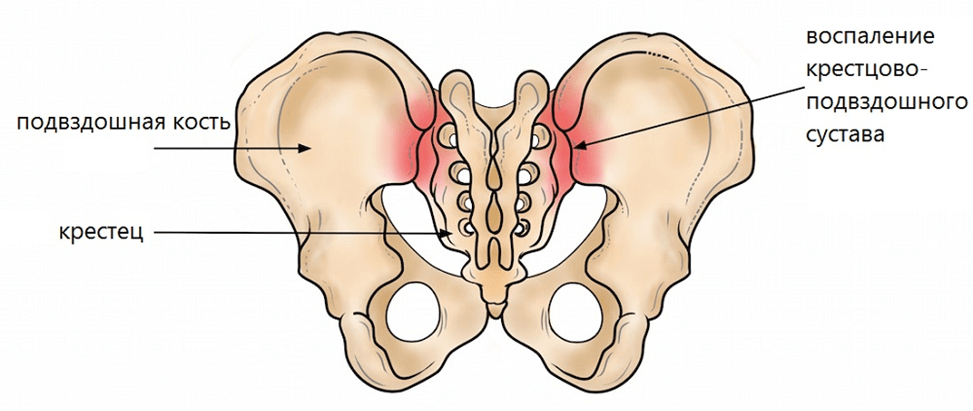 Артроз подвздошно-крестцовых сочленений
