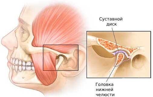 Артроз височно-нижнечелюстного сустава (ВНЧС)