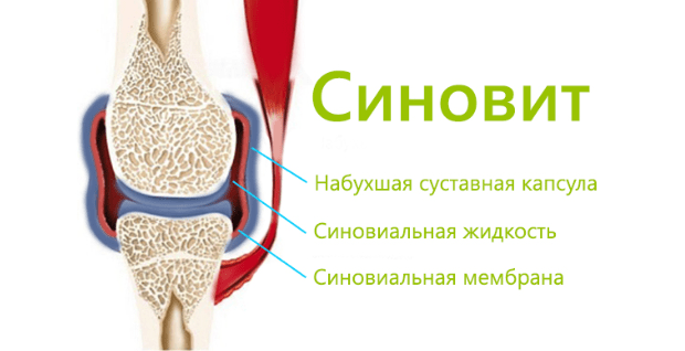 Лечение бурсита и синовита