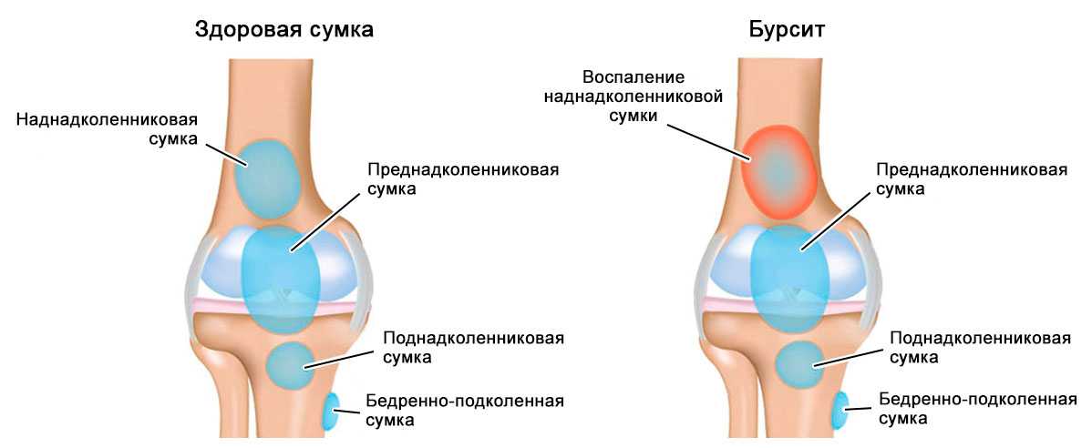 Лечение бурсита и синовита