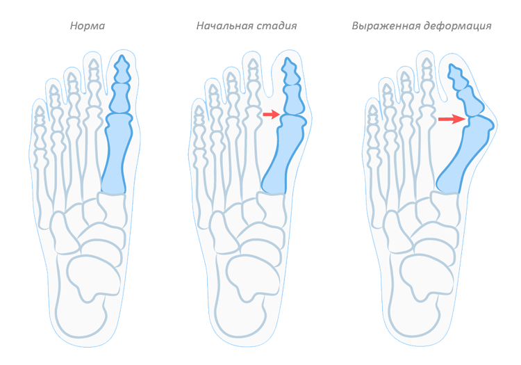 Вальгусная деформация стопы