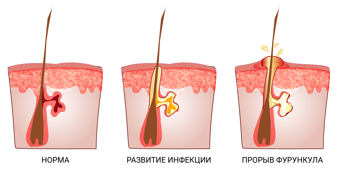 Карбункул, фурункул - причины и лечение