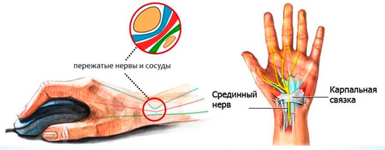 Синдром запястного канала