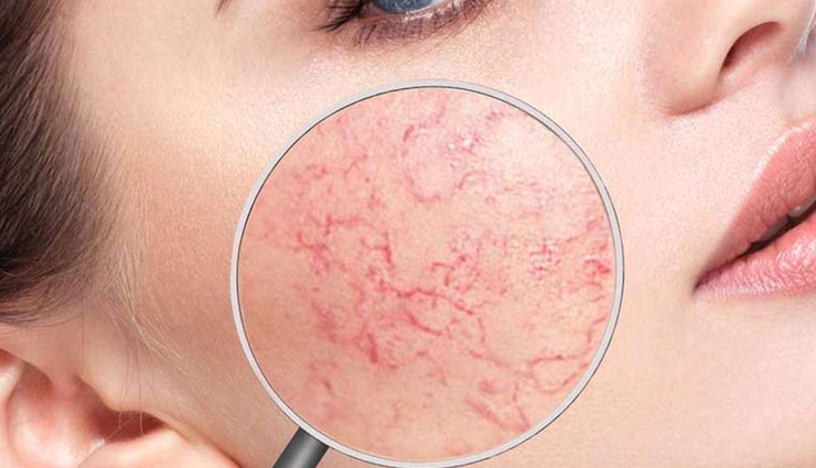 Лазерное удаление сосудистых звездочек - безопасность, эффективность и мгновенный результат