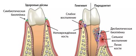 Пародонтит - как распознать, вылечить и сохранить зубы