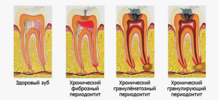 Хронический периодонтит - диагностика и лечение