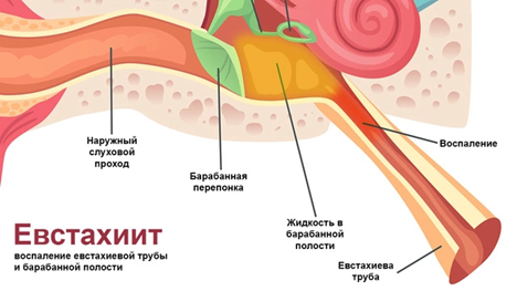 Лечение туботита в Москве