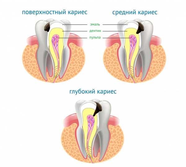 Чем поверхностный кариес отличается от среднего и глубокого