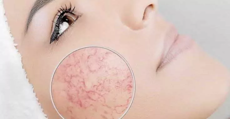 Лечение лазером телеангиоэктазий, розацеа, купероз