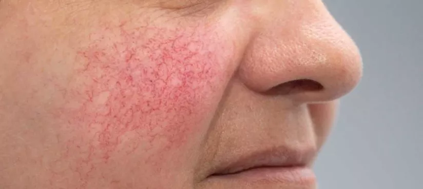 Лечение лазером телеангиоэктазий, розацеа, купероз