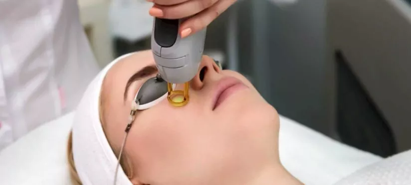 Лечение лазером телеангиоэктазий, розацеа, купероз