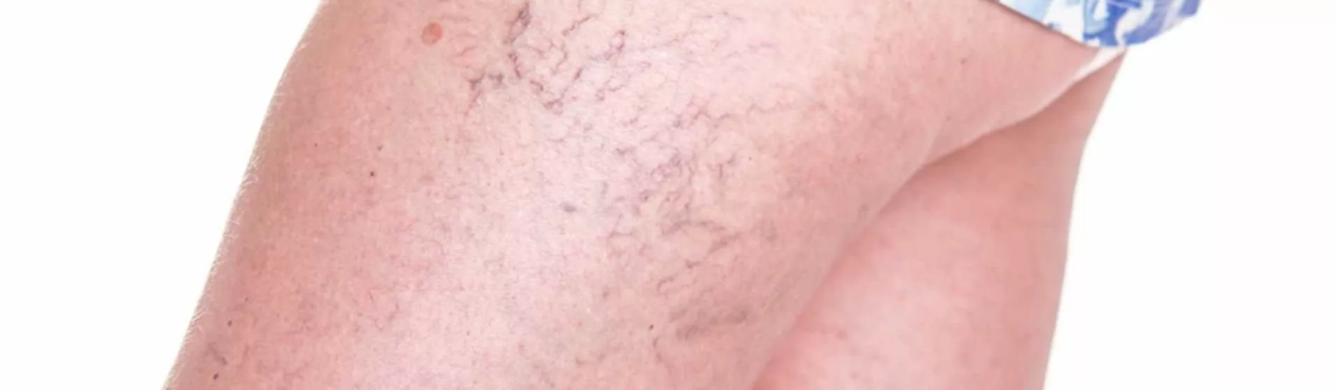 Лечение лазером ретикулярного варикоза