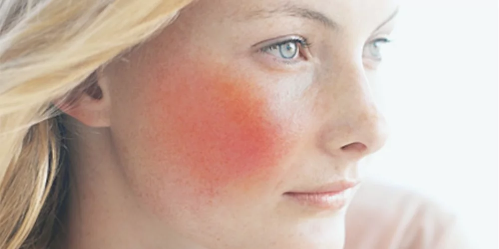 Лечение лазером телеангиоэктазий, розацеа, купероз