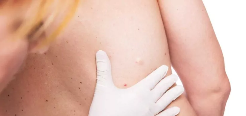 Лечение и диагностика атеромы