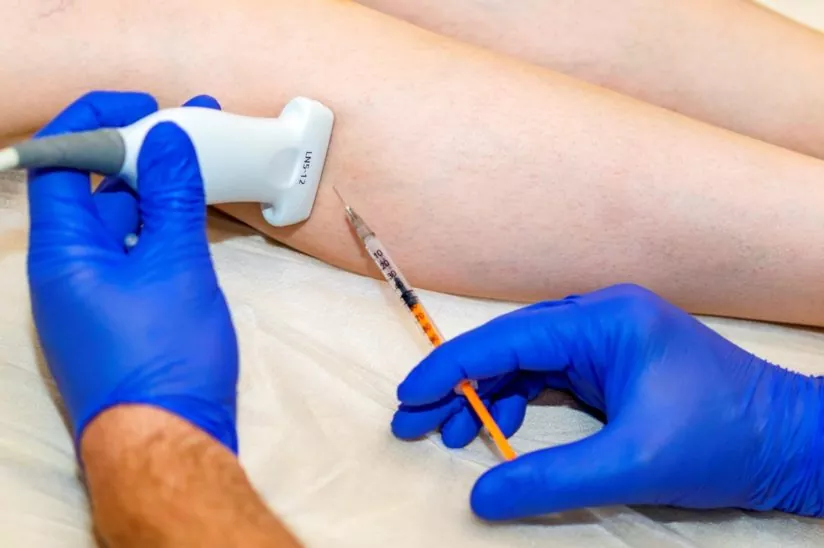 Склеротерапия вен нижних конечностей