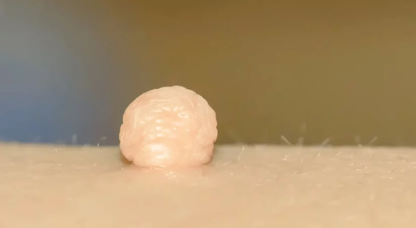 Лечение и удаление новообразований кожи