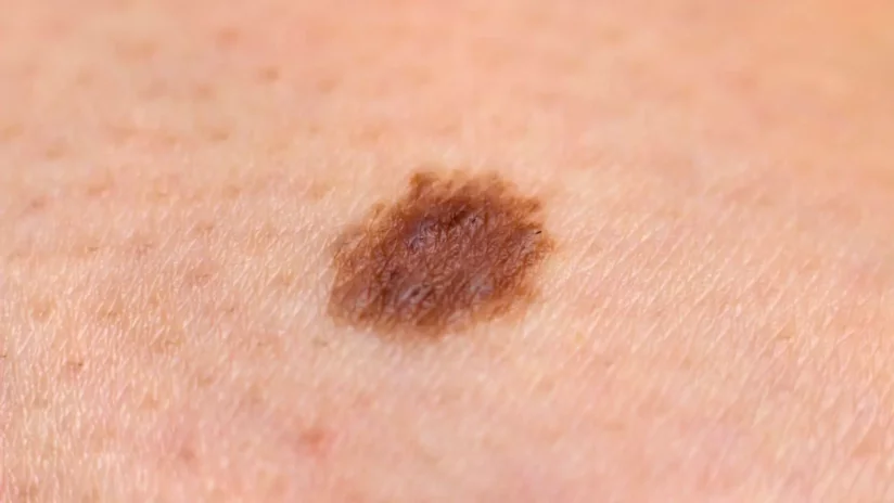 Лечение и удаление новообразований кожи