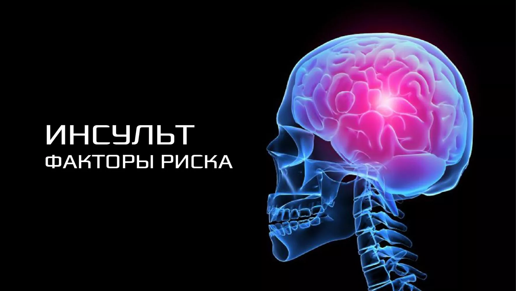 Виды, причины, диагностика и лечение инсульта