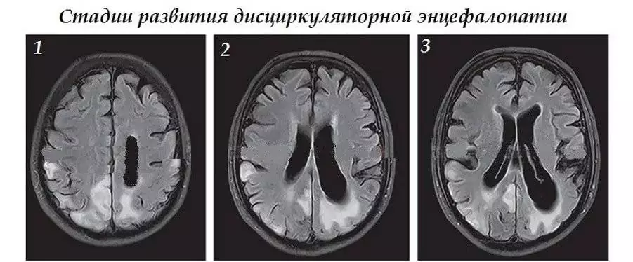 Дисциркуляторная энцефалопатия – причины, лечение