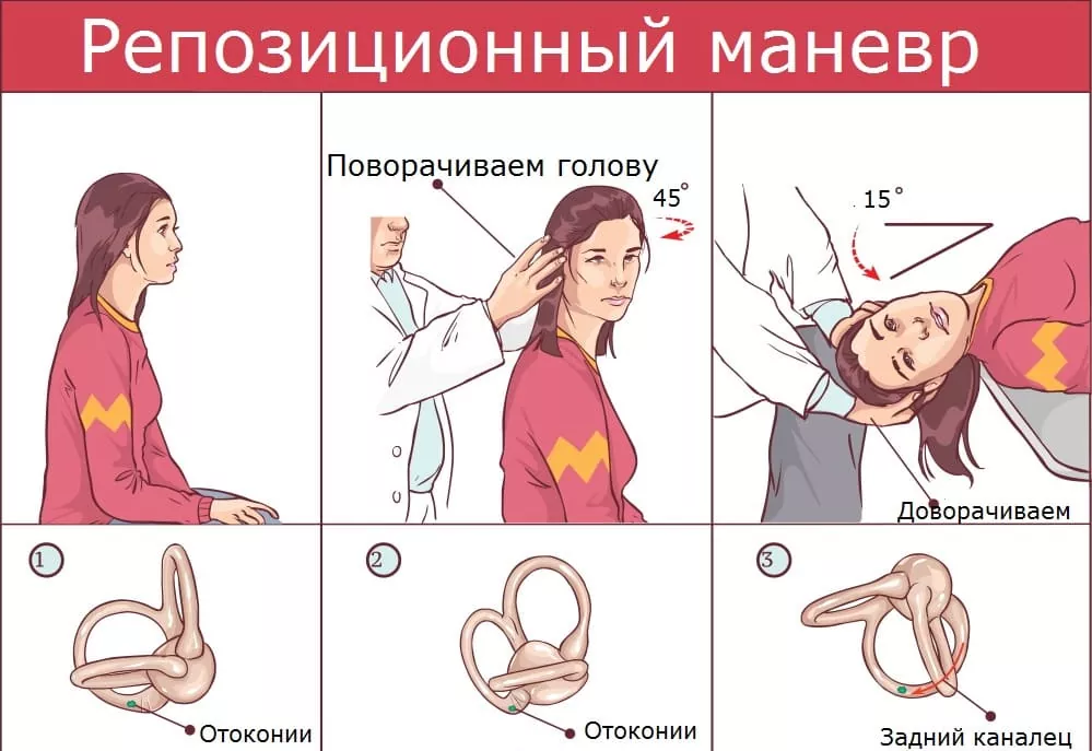 Доброкачественное пароксизмальное позиционное головокружение