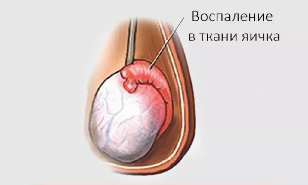 Орхит - диагностика, лечение