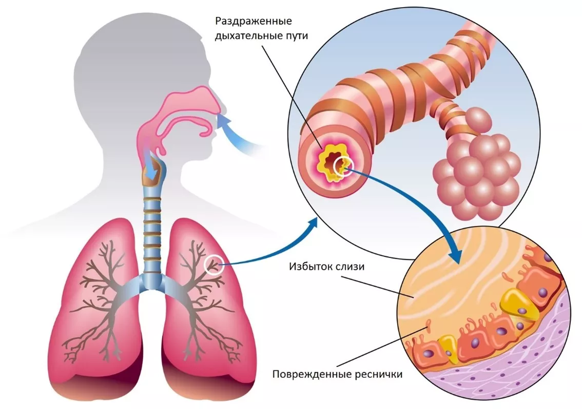 Бронхит - причины, лечение