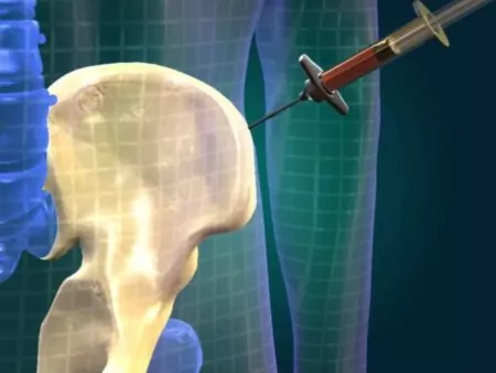 Внутрикостная терапия – новый эффективный метод устранения боли