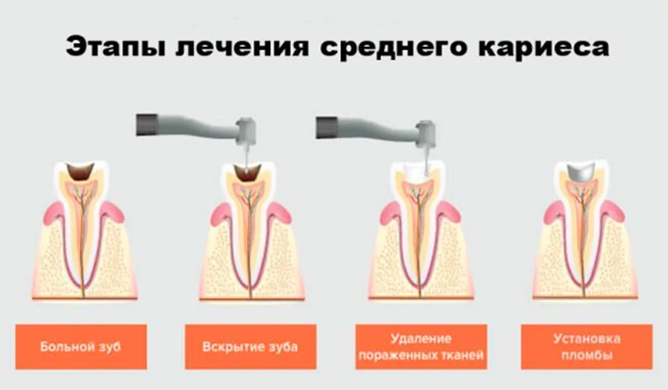 Лечение среднего кариеса в Москве