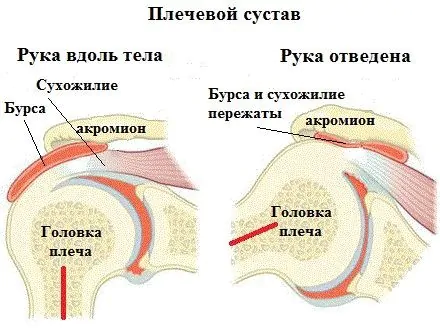 Импинджмент-синдром плечевого сустава — виды, лечение
