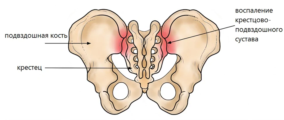Артроз подвздошно-крестцовых сочленений