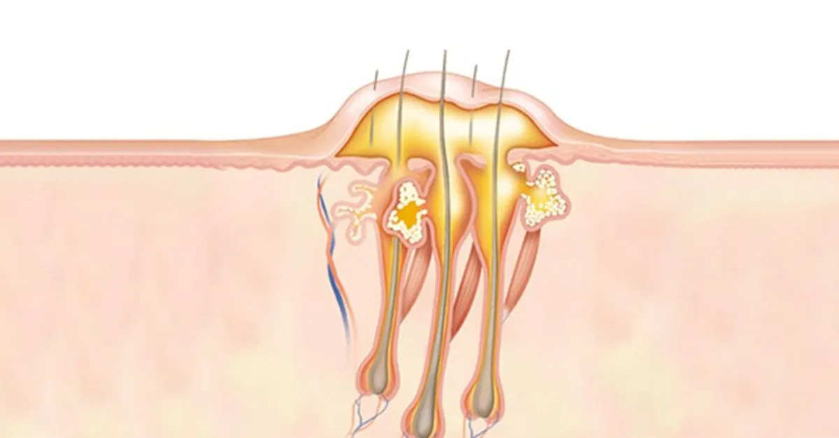 Карбункул, фурункул - причины и лечение